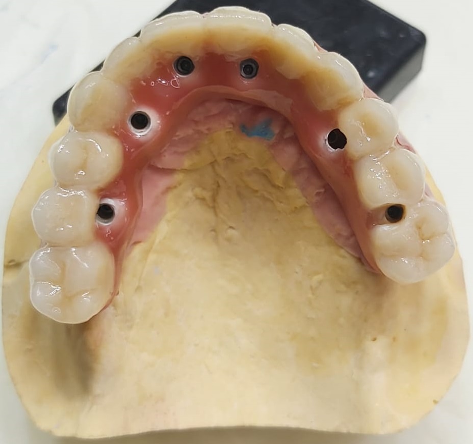 All-on-6 Bridge céramique sur 6 implants dentaires (1)