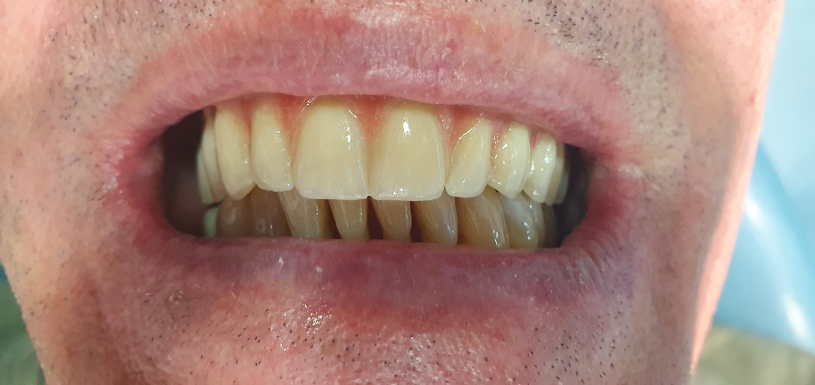 All-on-6 Bridge résine hybride céramique sur 6 implants dentaires