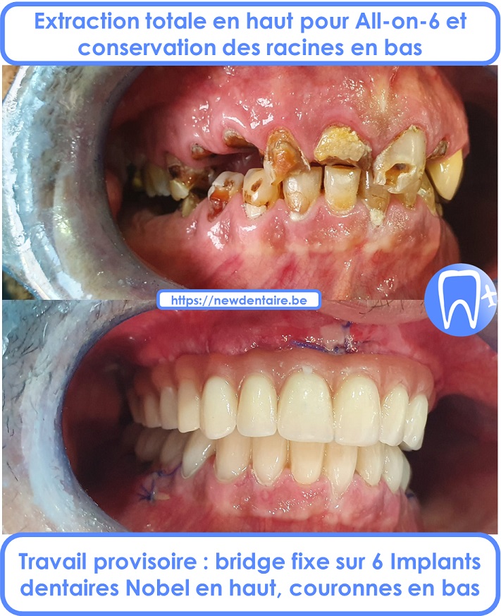 All-on-6 Nobel Biocare