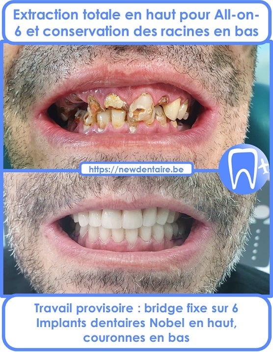 Charge immédiate sur implant All-on-6