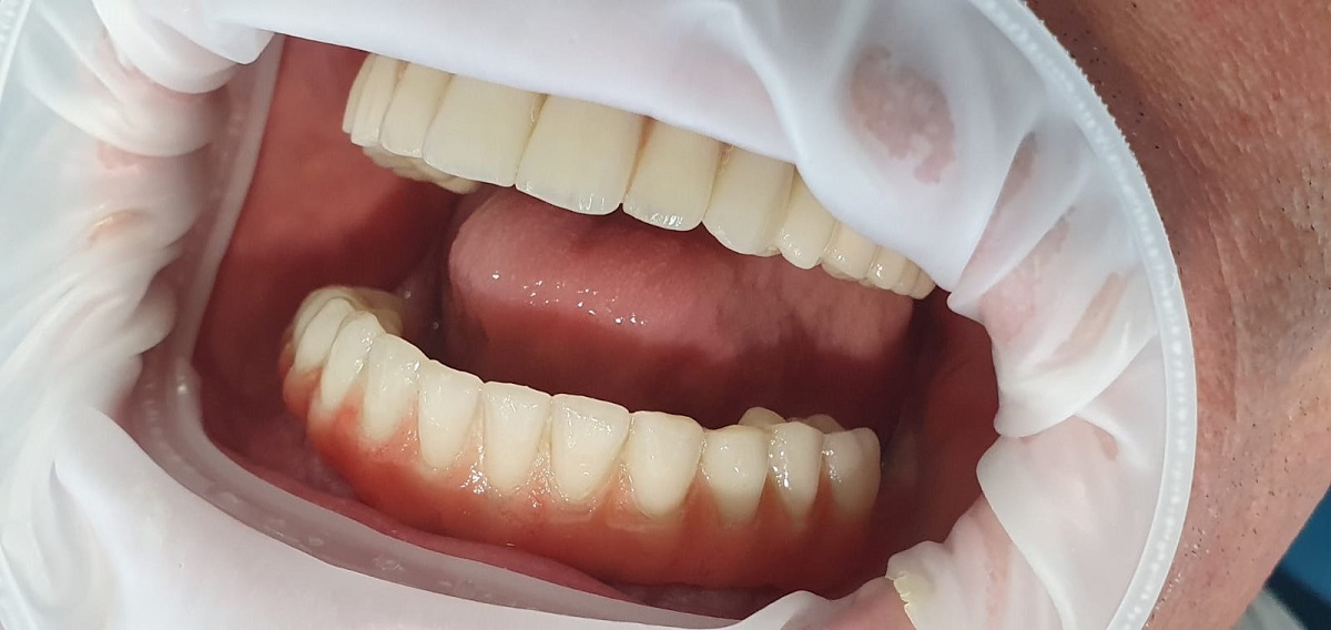 Allon4 - mâchoire inférieure (3)
