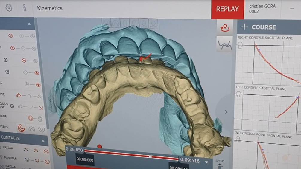 Analyse de l'occlusion numérique