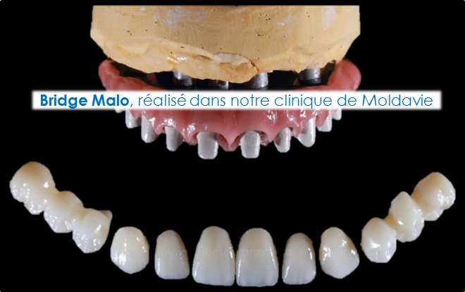 Matériau pour refaire ses dents : Bridge Malo