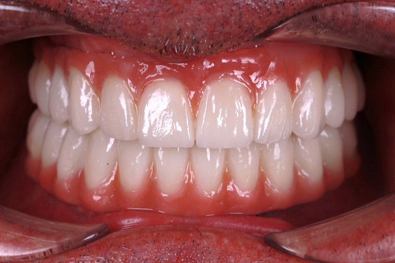 Bridge Métal-Céramique sur implants