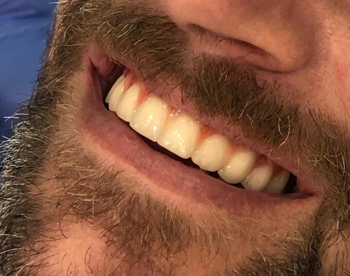 Bridge dentaire sur implant - Résine Peek transvissé