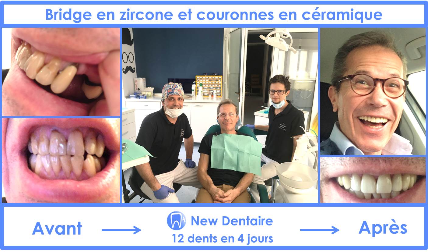 Bridge en Zircone et Couronnes Céramique en Roumanie