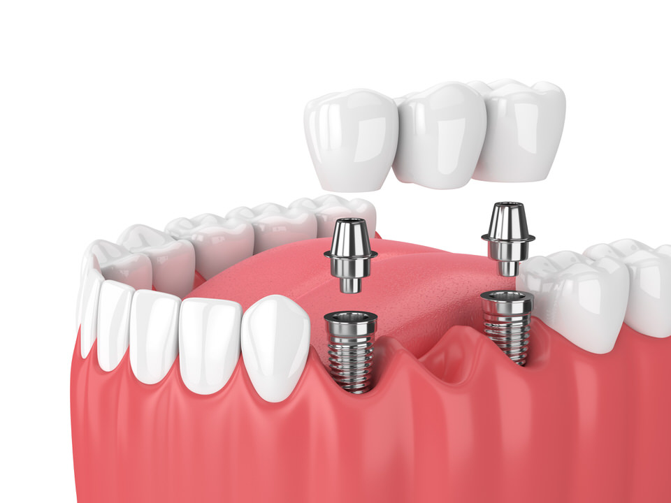Bridge fixe sur implant