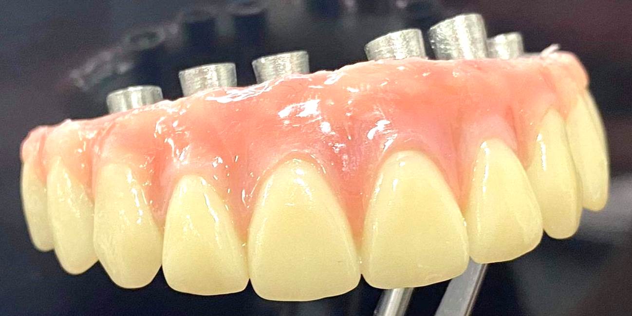 Bridge sur implant provisoire fixe
