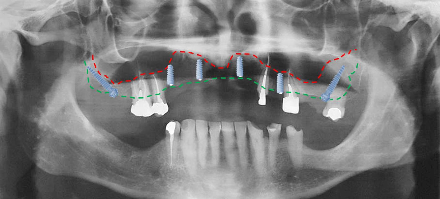 Cas clinique pour implant Ptérygoïdien