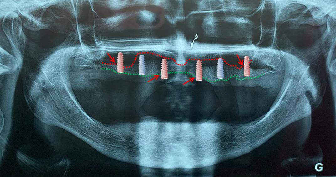 Cas clinique pour implantologie basale