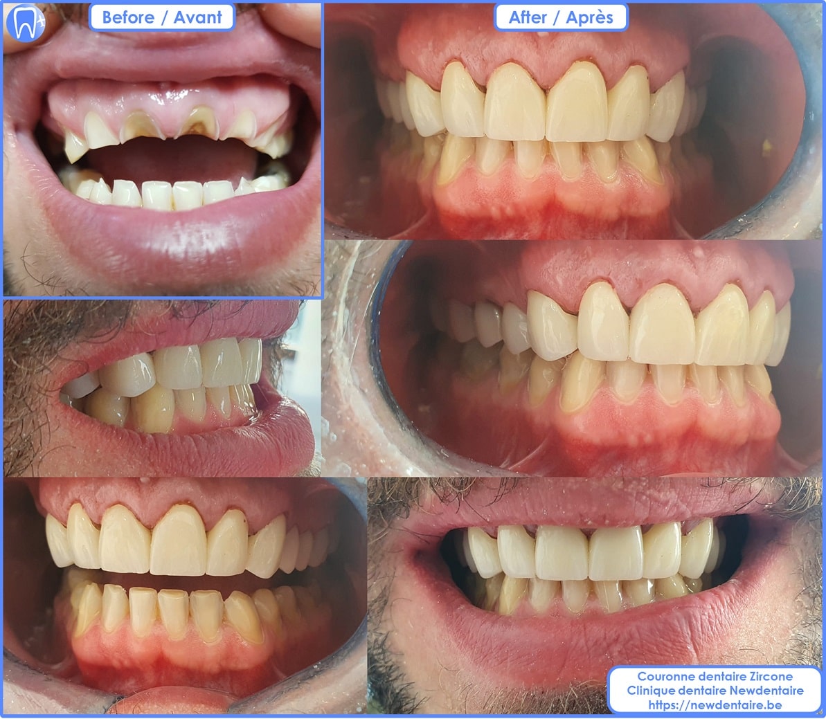 Couronne dentaire Zircone