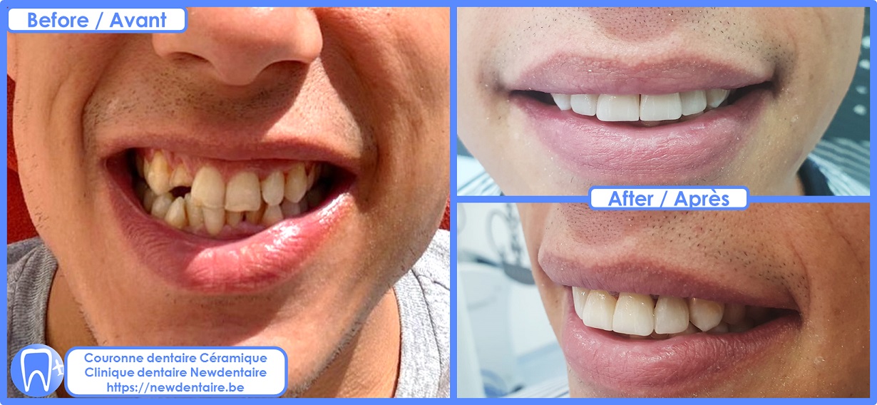 Couronne dentaire céramique EMAX Newdentaire