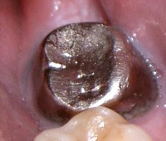 Couronne dentaire métallique