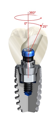 Couronne dentaire vissée sur implant