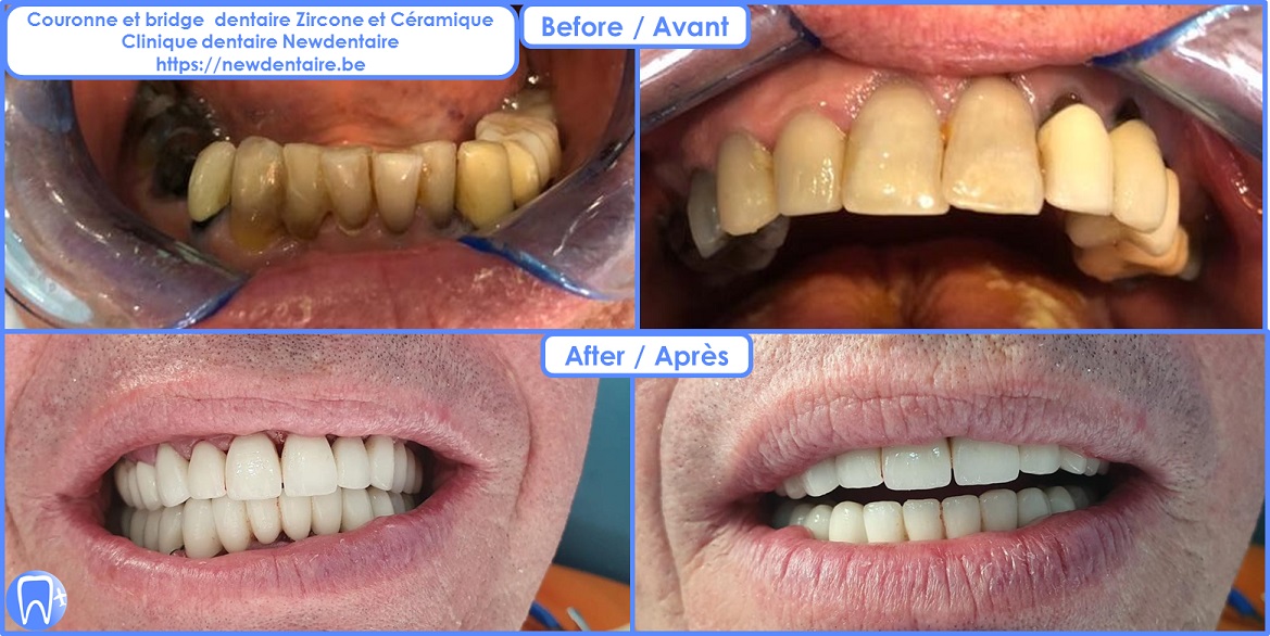 Couronne et bridge dentaire Zircone céramique