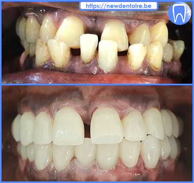 Couronnes dentaires céramique et implants dentaires 2