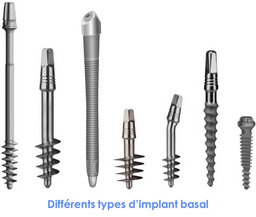 Différents types d'implant basal