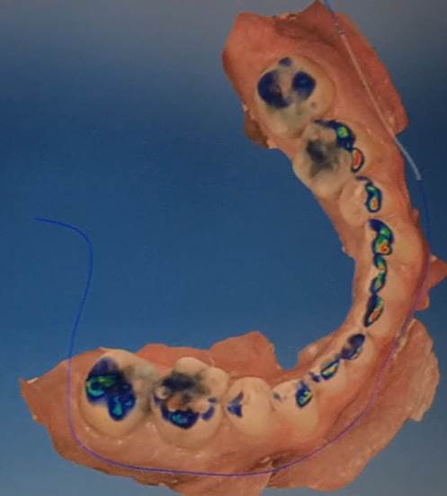Empreinte dentaire numérique