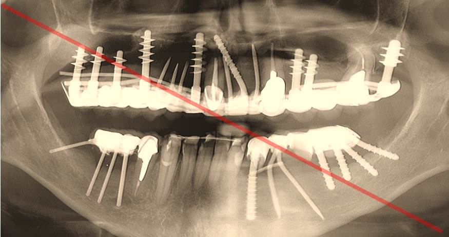 Exemple utilisation excessive d'implant basal