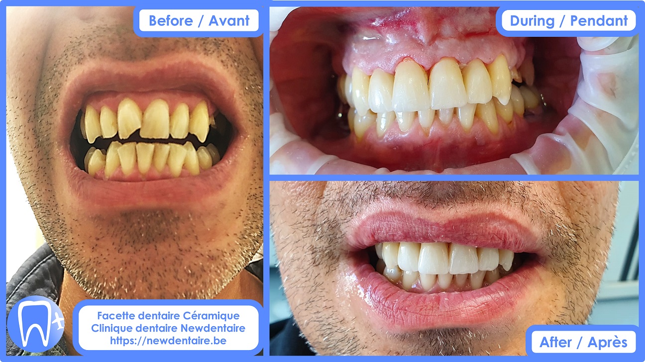 Facette dentaire Céramique Newdentaire