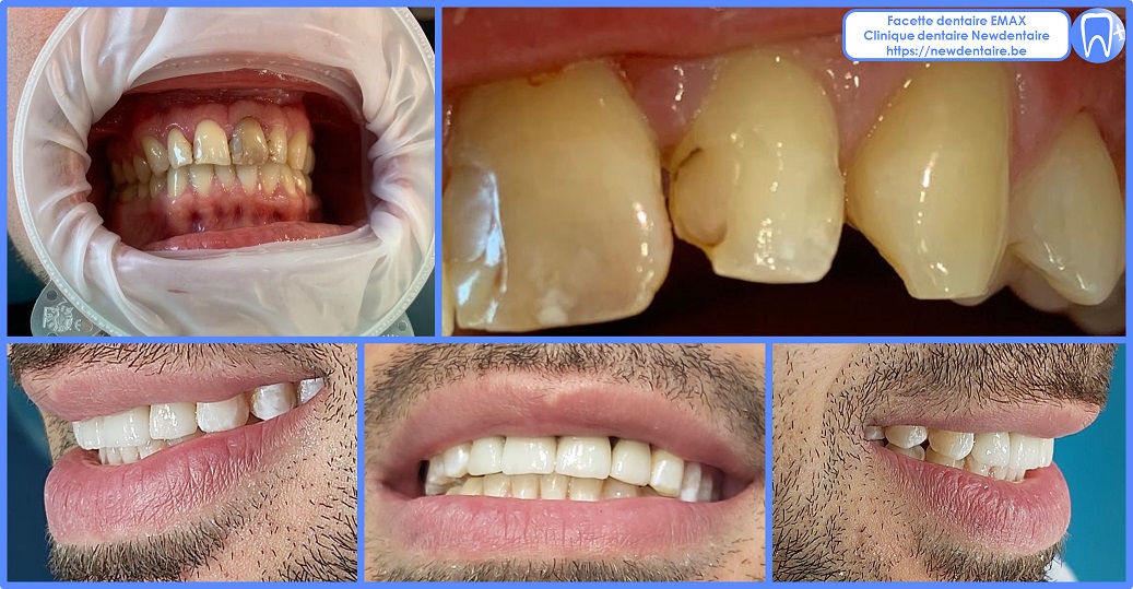 Facette dentaire Emax Newdentaire
