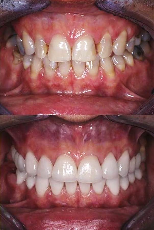 Facette dentaire avant après femme 1