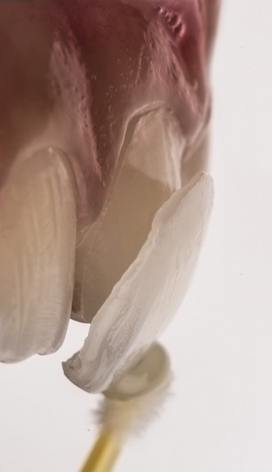 Facette dentaire avant collage