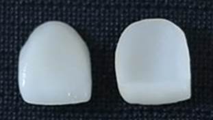 Facette dentaire avant pose