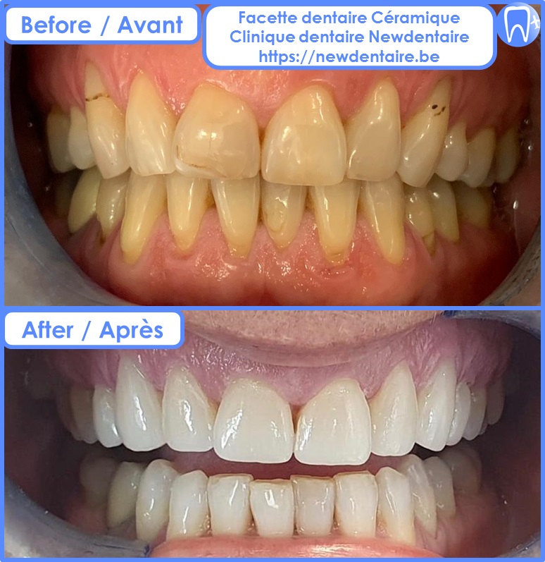 Facette dentaire céramique