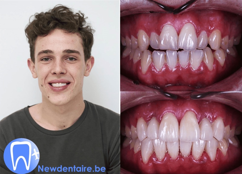 Hollywood smile ou sourire naturel