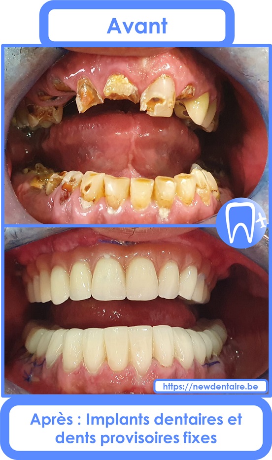 Implant dentaire All-on-6 Nobel Biocare avec dents provisoires fixes