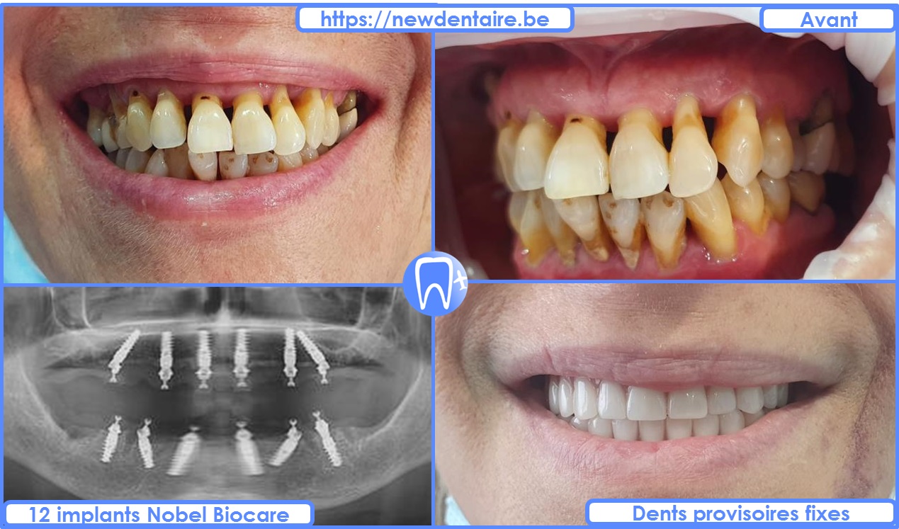Implant dentaire All-on-6 Nobel Biocare - dents provisoires fixes