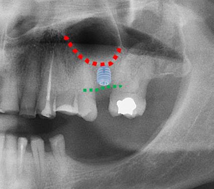 Implant dentaire court