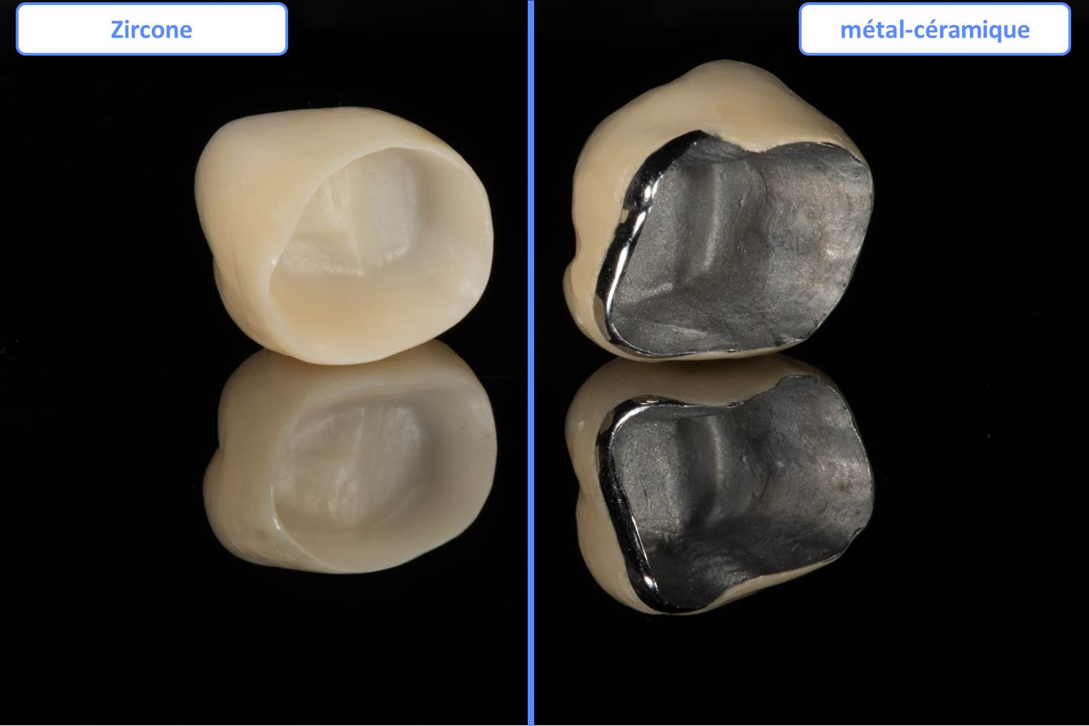 Zircone Vs Métal-céramique