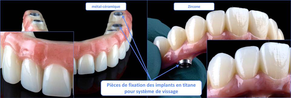 Métal-céramique Vs Zircone