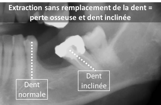 Molaire inclinée suite extraction dentaire