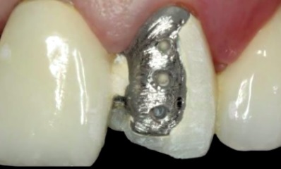 Métal-céramique cassée avec metal visible