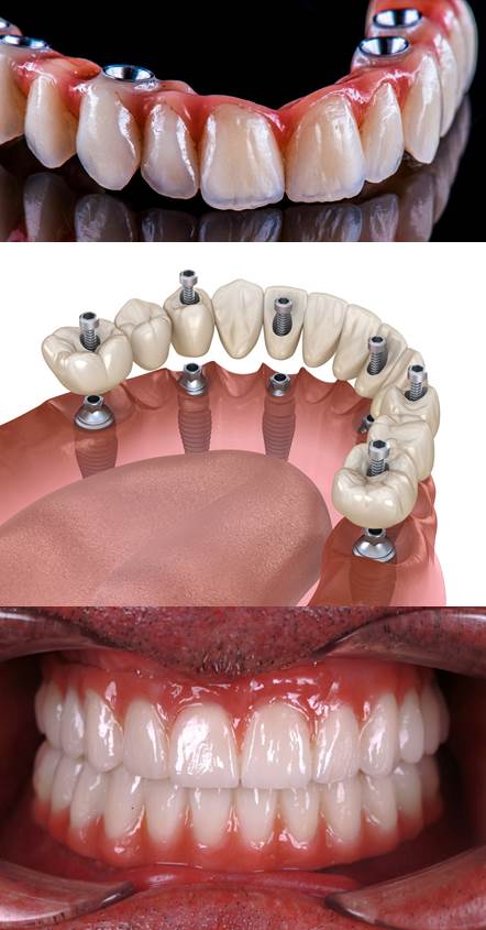 Prix pour refaire toutes ses dents en une seule fois