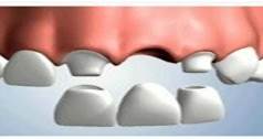 Prothèse Bridge sur dent