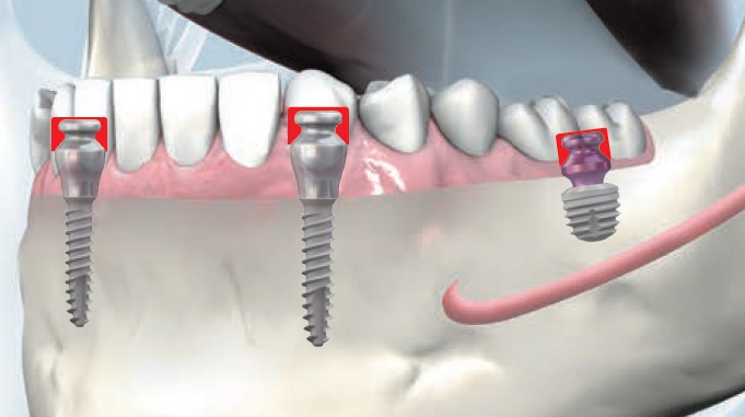 Prothèse fixe avec implants Bredent