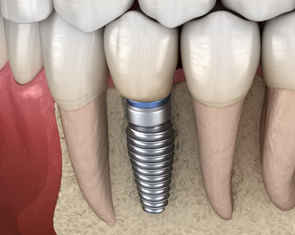 Prothèse fixe - couronne sur implant dentaire