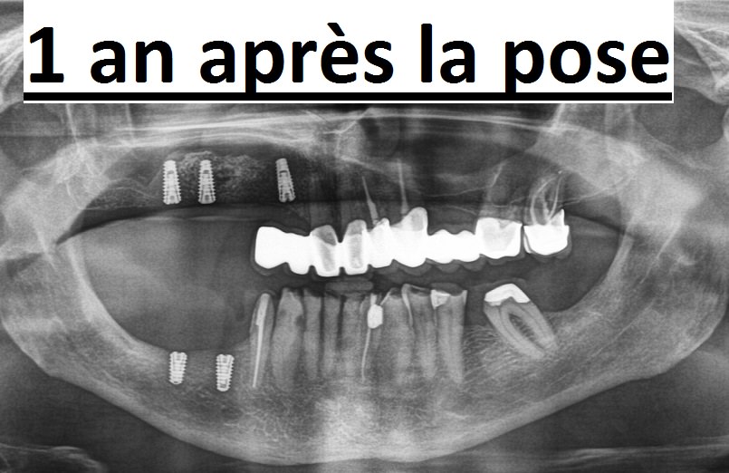 Radio panoramique de contrôle pour entretien des implants