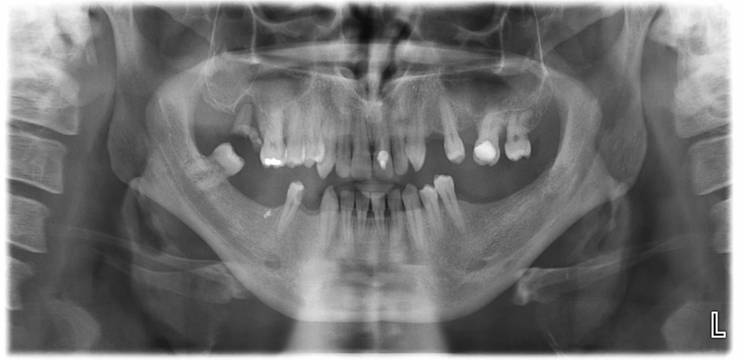 Radiographie dentaire panoramique