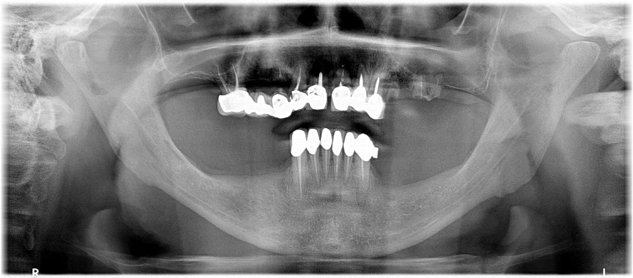 Radiographie panoramique