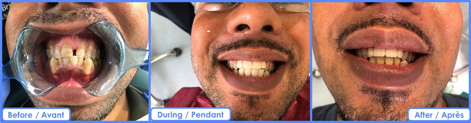 Soin dentaire esthétique