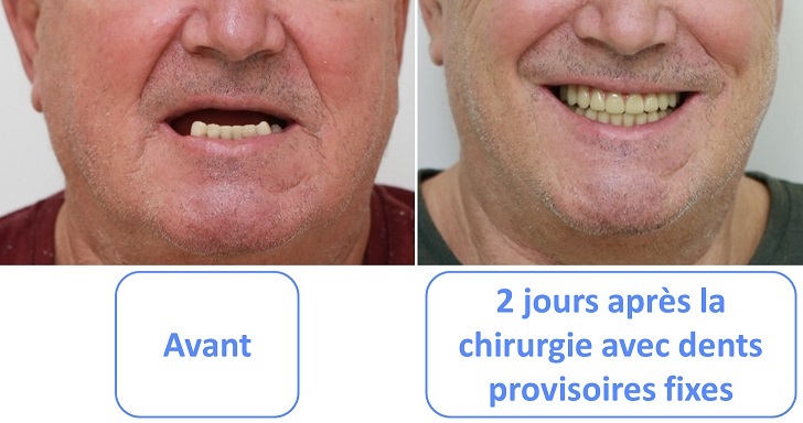 avant après charge immédiate sur implant dentaire