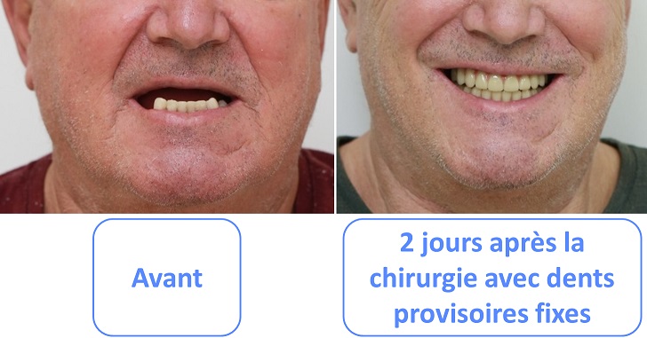 avant après Allon6 avec dents provisoires fixes
