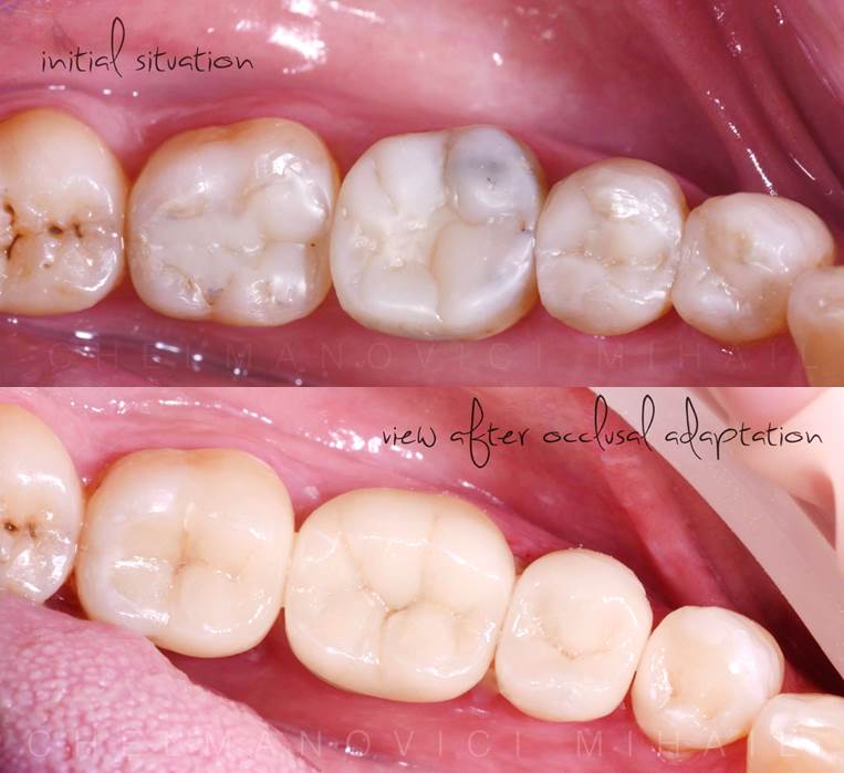 avant et après facette dentaire pour Bruxisme