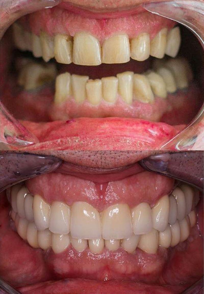 Résultat durable après implant dentaire et couronnes céramiques