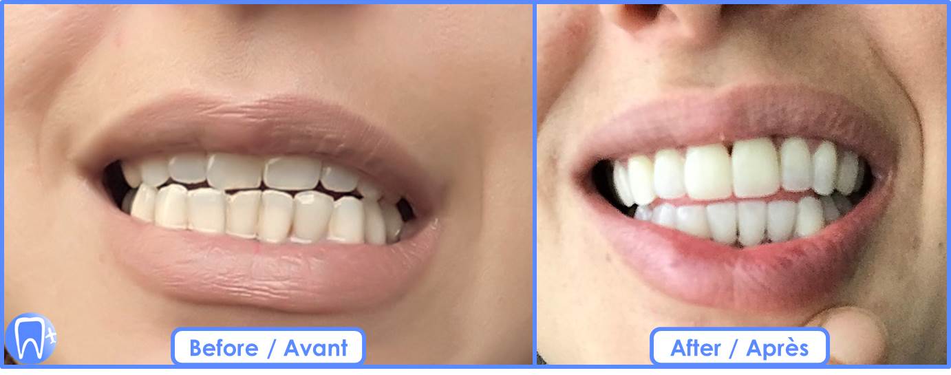 esthétique facette dentaire